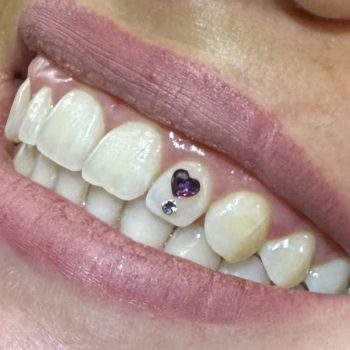 Samantha Vonviper Strass Dentaire